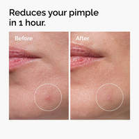 The Ordinary Sulfur 10% Powder-to-Cream Concentrate – Targeted Acne & Blemish Treatment