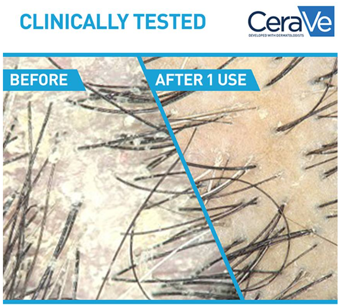 Anti-Dandruff Hydrating Shampoo – Fights Flakes & Itch While Nourishing Dry Scalp