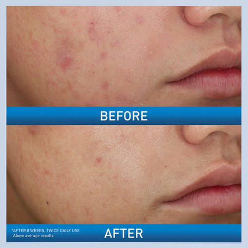 Acne Foaming Cream Wash – Deep-Cleansing Formula for Acne-Prone Skin |Cerave