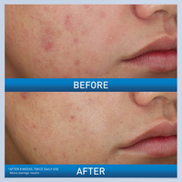 Acne Foaming Cream Wash – Deep-Cleansing Formula for Acne-Prone Skin |Cerave