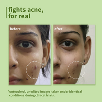 Green Tea Pore Cleansing Face Wash for Acne 150ml