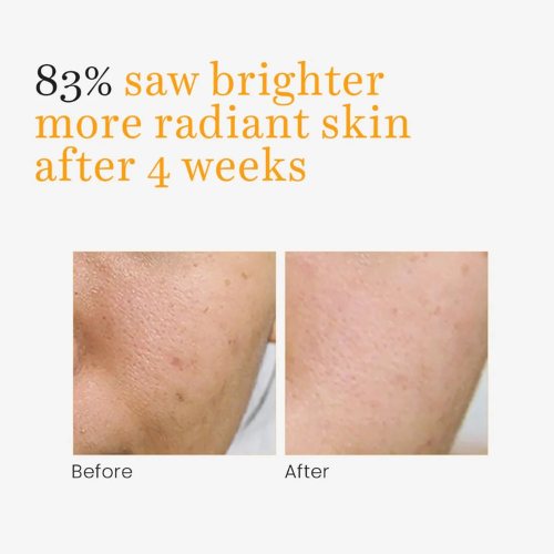 O3+ Vitamin-C Serum Glow for Dark Spots and Pigmentation (30ml)