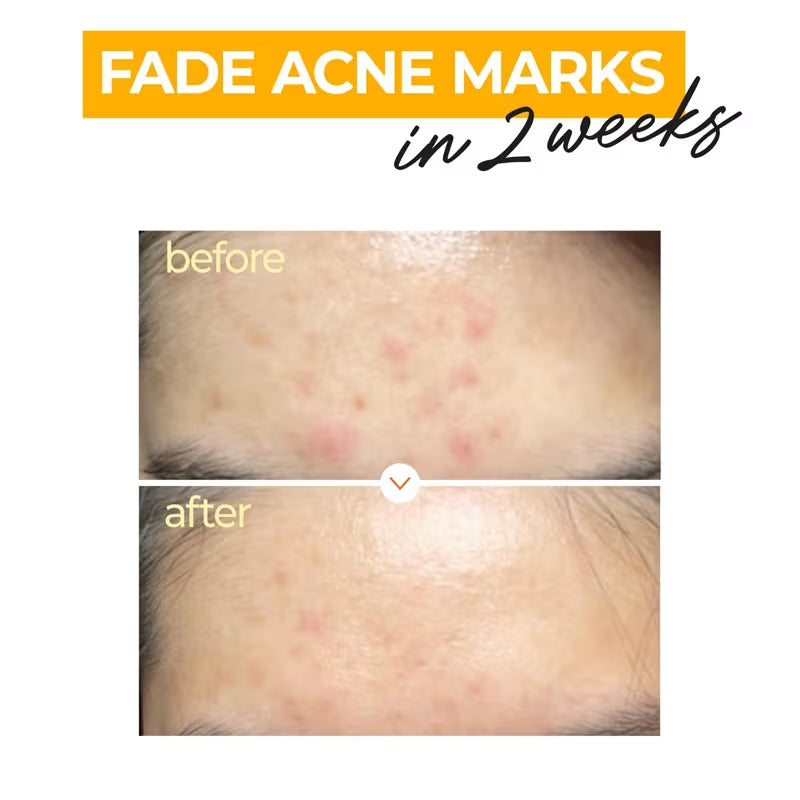 Numbuzin No.5 Vitamin Concentrated Serum (30ml) | TXA & Niacinamide for Hyperpigmentation