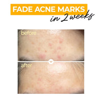 Numbuzin No.5 Vitamin Concentrated Serum (30ml) | TXA & Niacinamide for Hyperpigmentation